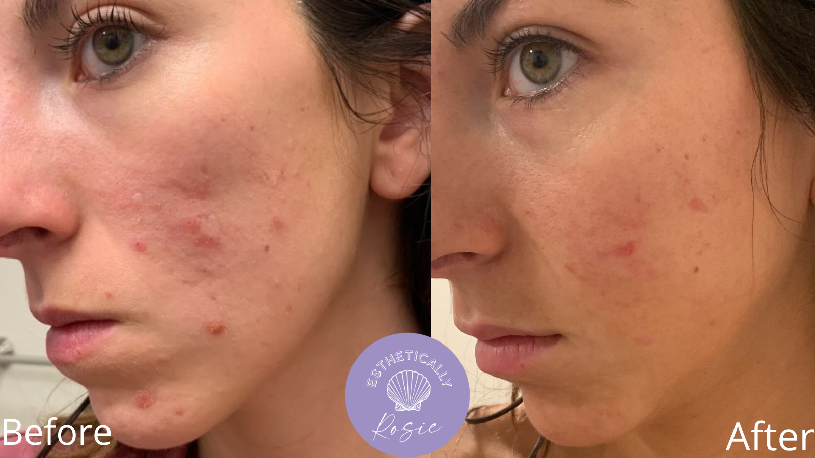 Before and after acne facial treatment
