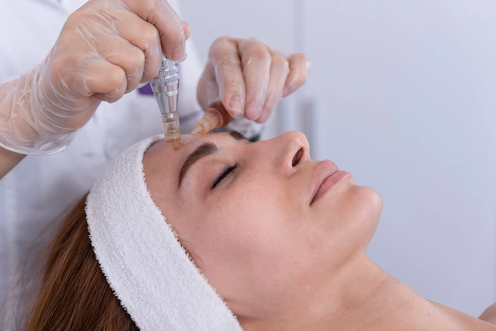 Microdermabrasion treatment at Esthetically Rosie in Redlands